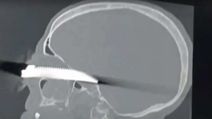 Un Tucumano ingresó al Hospital Padilla con un cuchillo clavado en el ojo